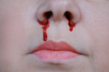 bright red blood flows from nostril, bright red blood flows from nostril, close-up part of face,...