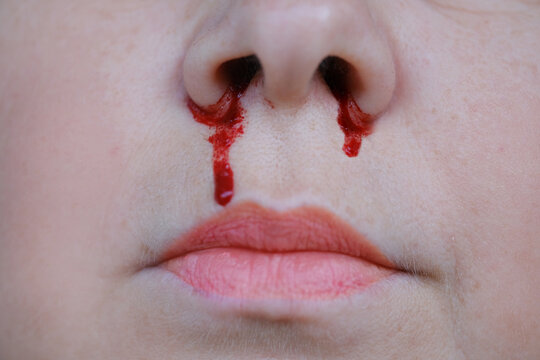 bright red blood flows from nostril, bright red blood flows from nostril, close-up part of face, fragility of blood vessels, heart diseases, sharp increase in blood pressure
