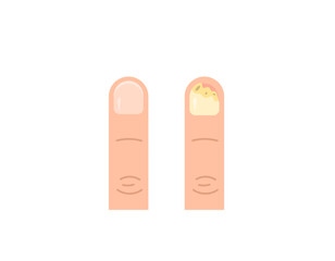 illustration of yellow, thickened, brittle fingernails. nail fungus, Onychomycosis, fungal infection. sign of diabetes. nail health problems illustration design. vector elements. white background