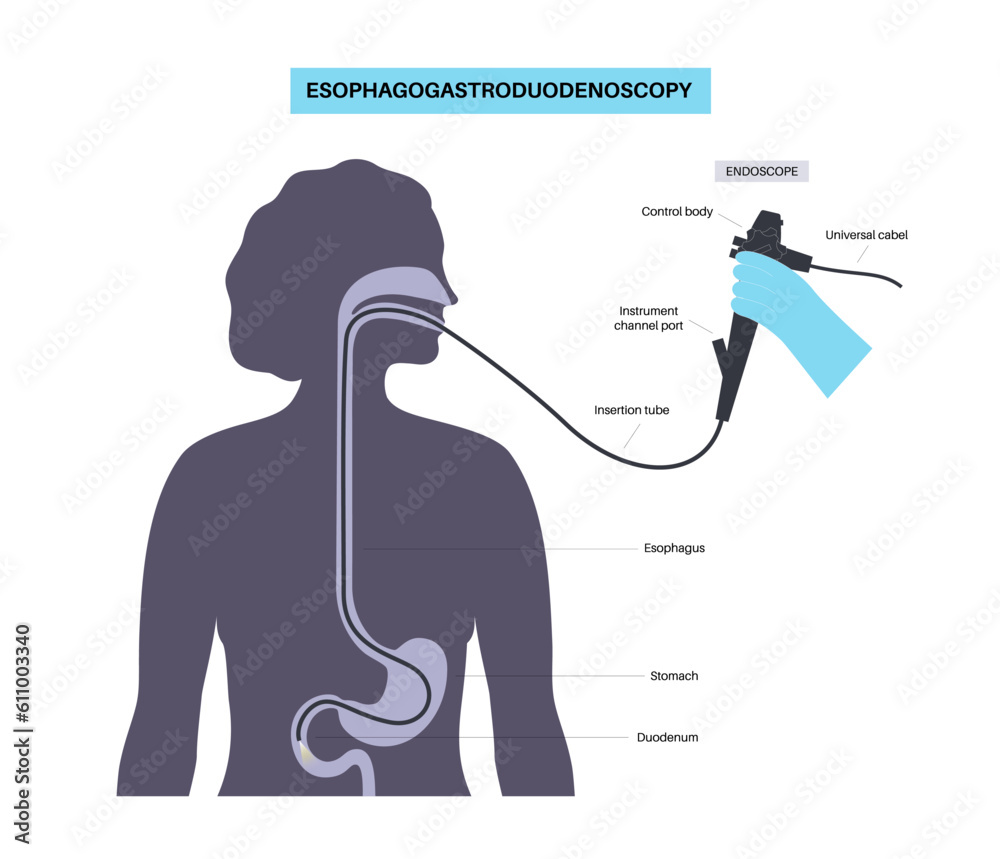 Canvas Prints Gastroscopy endoscopy procedure