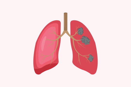 lung cancer and normal lung illustration comparation. health and unhealth lug. eps 10.  icon set