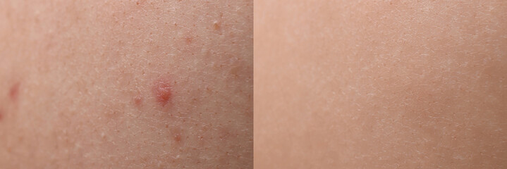 Fototapeta premium Collage with photos of person suffering from acne before and after treatment, closeup. Banner design showing affected and healthy skin