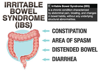 Irritable Bowel Syndrome (IBS) Infographic