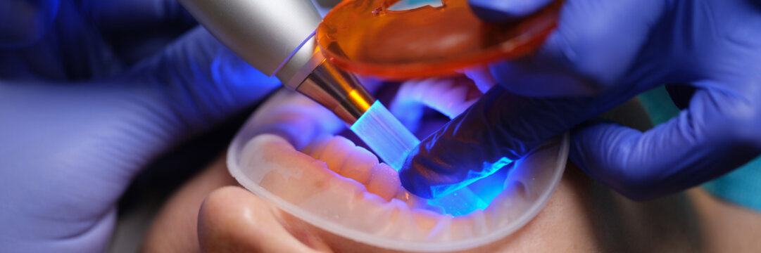 Dentist treating caries and illuminating seal with ultraviolet lamp closeup. Modern dentistry concept - Powered by Adobe