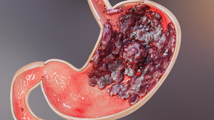 Stomach cancer. stages tumor growth in digestive system, Peptic Ulcer, Cancer attacking cell. gastric disease concept. symptoms, malignant cancerous, viruses and bacteria, Cross section, 3d render - obrazy, fototapety, plakaty