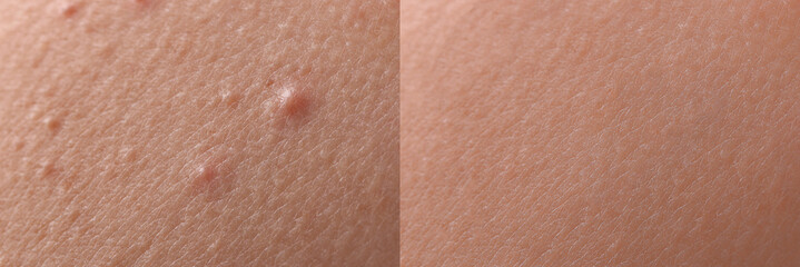 Collage with photos of person suffering from acne before and after treatment, closeup. Banner...