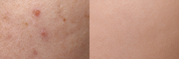Fototapeta premium Collage with photos of person suffering from acne before and after treatment, closeup. Banner design showing affected and healthy skin