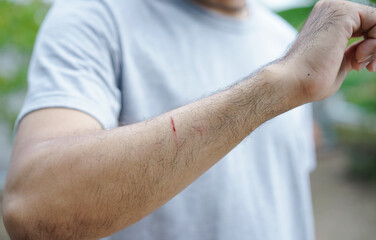 Close up of man's arm with bleeding wound from accident. A man showing an arm with a wound bleeding...
