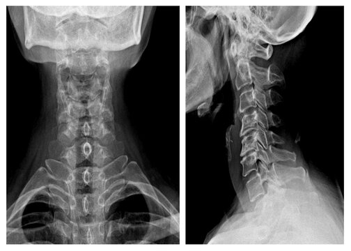 X-ray image photo of human neck