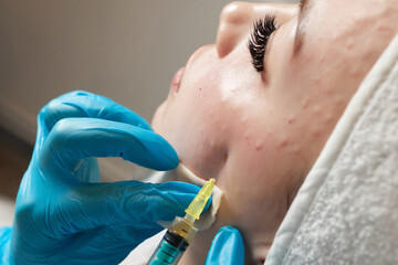 Syringe with a patient's blood plasma in a cosmetologist's hand for a plasmolifting of a woman's...