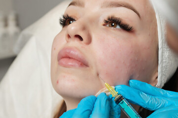 Syringe with a patient's blood plasma in a cosmetologist's hand for a plasmolifting of a woman's...