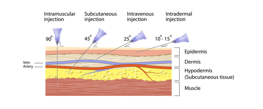 Types of injection vector illustration. intramuscular, subcutaneous, intravenous, intradermal. skin layers types epidermis, dermis, hypodermis and muscle. Basic Medical science study material. layers