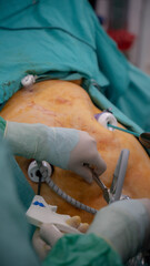 Obesity surgery. Weight loss surgery with laparoscopy technique.