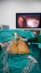 monitor during laparoscopy surgery. Obesity surgery and monitor in the operating room