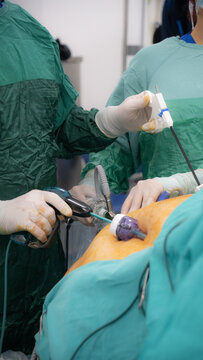 Obesity surgery. Weight loss surgery with laparoscopy technique.