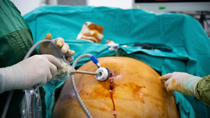 Obesity surgery. Weight loss surgery with laparoscopy technique.