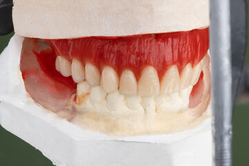 Artificial teeth arrangement in waxed up complete denture.
