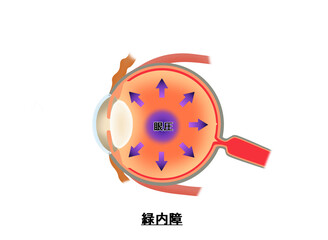 緑内障の仕組み　解説図