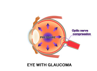緑内障の仕組み　解説図