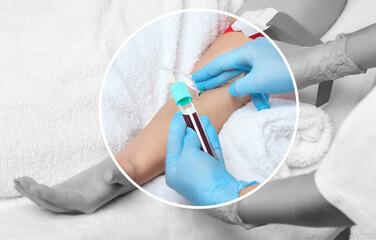 The procedure for taking blood from a vein to separate blood plasma in a centrifuge.Prp procedure