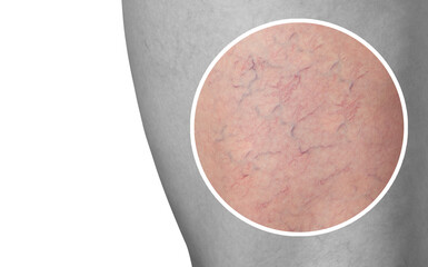 Varicose veins and capillary veins in the legs. Medical inspection and treatment of Telangiectasia.