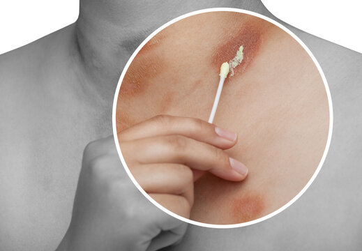 One person with Pityriasis rosea disease on the chest and neck on an isolated background. Applying ointment to the affected area of the skin.