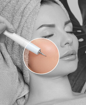 The cosmetologist makes the procedure treatment of Couperose of the facial skin of a beautiful, young woman in a beauty salon.Cosmetology and professional skin care.