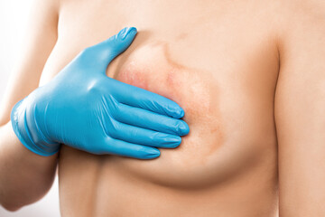 A woman shows a burn on her chest, healing of the skin after a burn with boiling water....