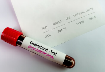 Blood sample with abnormal high report of Cholesterol test. hypercholesterolemia