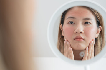 Woman worried about face Dermatology, rosacea dermatitis, allergic steroids, sensitive skin, red...