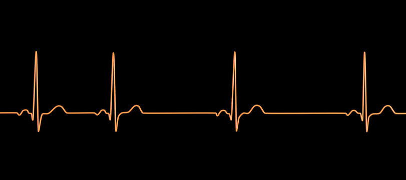 Electrocardiogram ECG displaying sinus arrhythmia, 3D illustration
