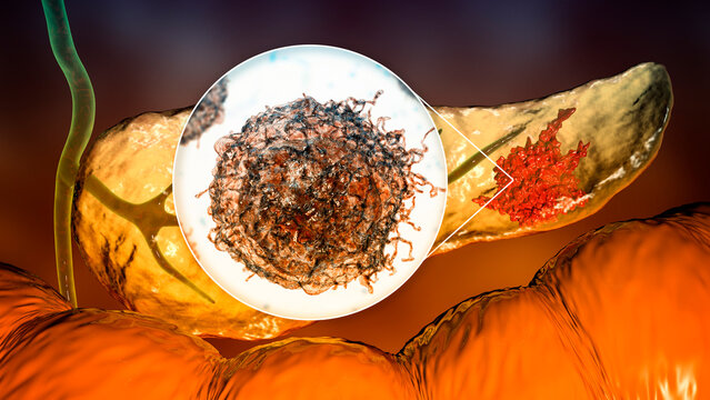 Pancreatic cancer, tumor of pancreas with close-up view of cancer cells, 3D illustration