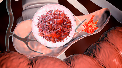 Pancreatic cancer, tumor of pancreas with close-up view of cancer cells, 3D illustration - obrazy, fototapety, plakaty
