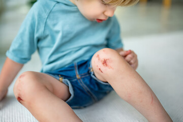 Toddler boy with scraped knees. Parent helping her child perform first aid knee injury after an...