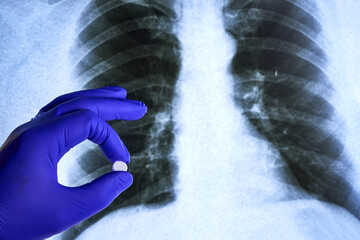 a hand in a blue medical glove holds a pill against the background of an X-ray of the lungs