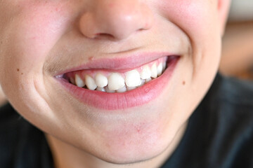 Close up of happy smile of little boy.  Dental medical care.  Dental  bruxism treatment . Invisible braces. Silicone trainer. 
