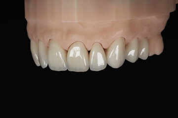 A model of upper jaw with veneer teeth. Dentist office. Close-up photo isolated on black background.