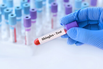 Doctor holding a test blood sample tube with Shingles test on the background of medical test tubes with analyzes