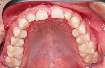 Dentistry case of upper maxillary arch, indirect occlusal view with buccal photography mirror. Healthy gingival gum,palate, teeth aligned with a diastema gap between the central incisors and no decay. © MSC