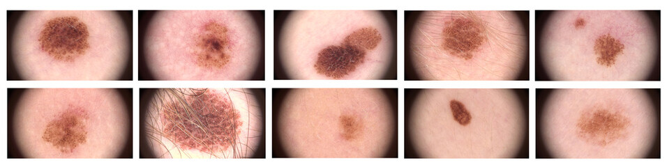 Complex melanocytic nevus. Dermatoscopy of the skin. Macro magnified 20 times with a dermatoscope microscope. A set of different nevus. Examination by a dermatologist. Mole birthmark closeup.