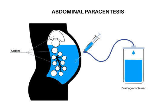 Abdominal paracentesis poster