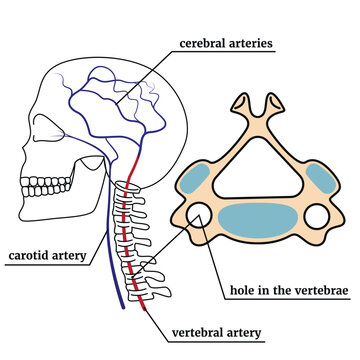 The contour of the skull with the spine. Infographic with vertebral artery syndrome. Medical poster. Vector illustration