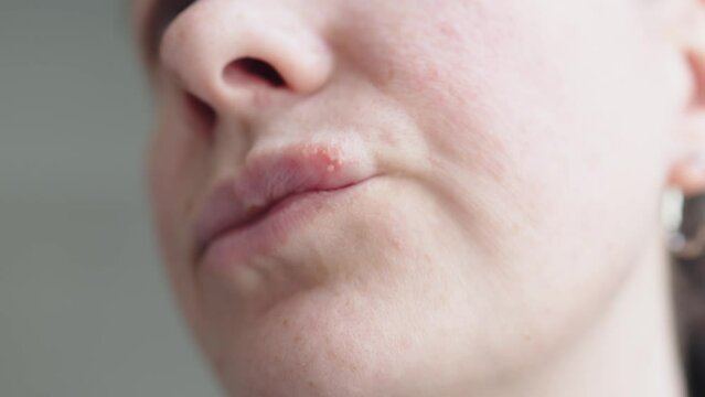 woman with sore on lips herpes simplex virus, vesicles on lip skin with herpes virus ulcers. close-up herpes sores small bumps on upper lip corner female face. Caucasian female lips with herpes pimple
