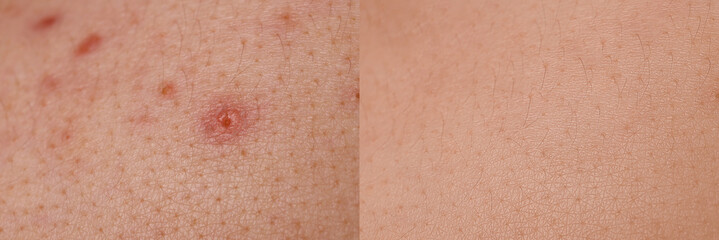 Fototapeta premium Collage with photos of person suffering from acne before and after treatment, closeup. Banner design showing affected and healthy skin