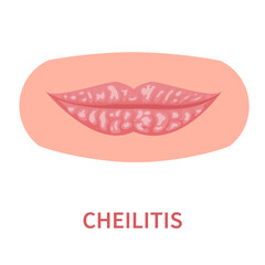 Cheilitis oral disease icon. Lips inflamation and irritation with cracking and peeling skin. Dermatitis outbreak. Medical concept. Vector illustration isolated on white.