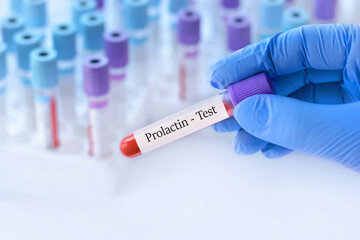 Obraz premium Doctor holding a test blood sample tube with Prolactin test on the background of medical test tubes with analyzes.