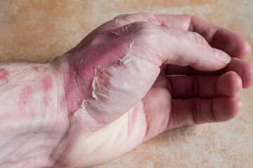 A close-up of a partially burned hand with a second-degree burn, revealing redness, cracking, and changing skin texture. First aid, wound healing, burn recovery.