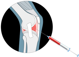 injection into the painful joint