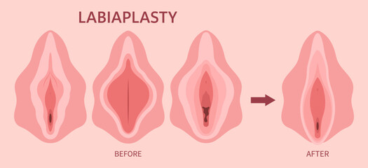 Female Vulvoplasty the menopause women genital of minor Vulval labia loose lips beauty surgery to tighten Hood Dry vagina disease and posterior colporrhaphy reconstruction male by the Dyspareunia pain