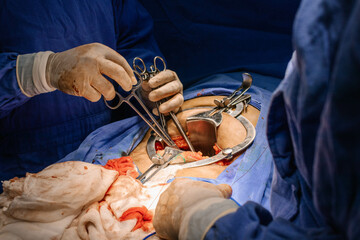 Obraz premium Histerectomía 